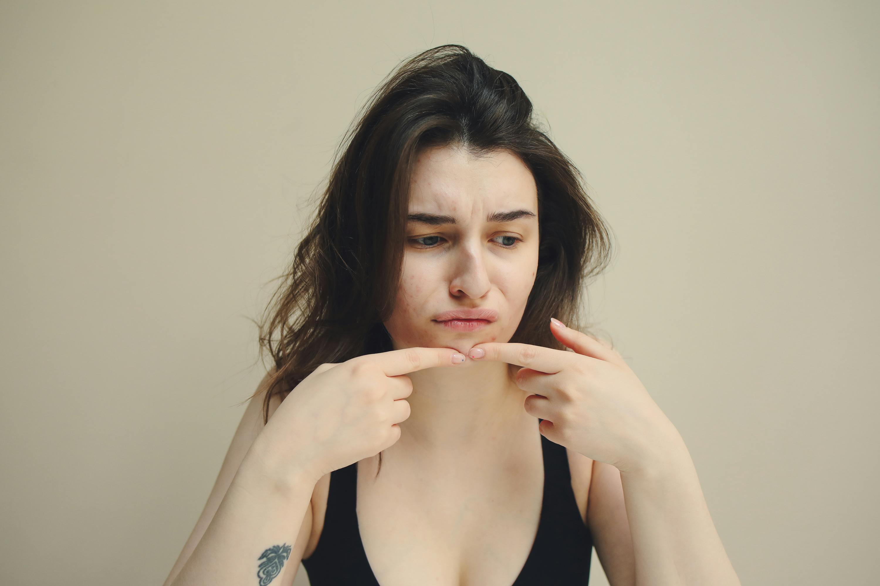 young woman with acne