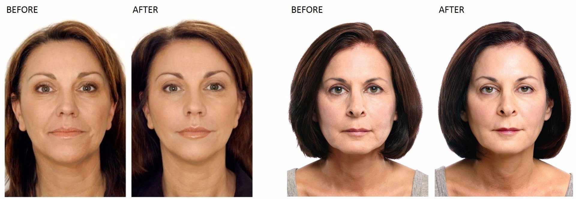 Botox and Cosmetic Injections at Total Body Care