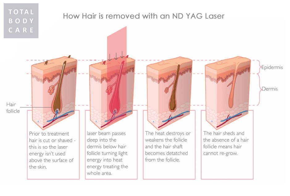 Laser Hair Removal at Total Body Care