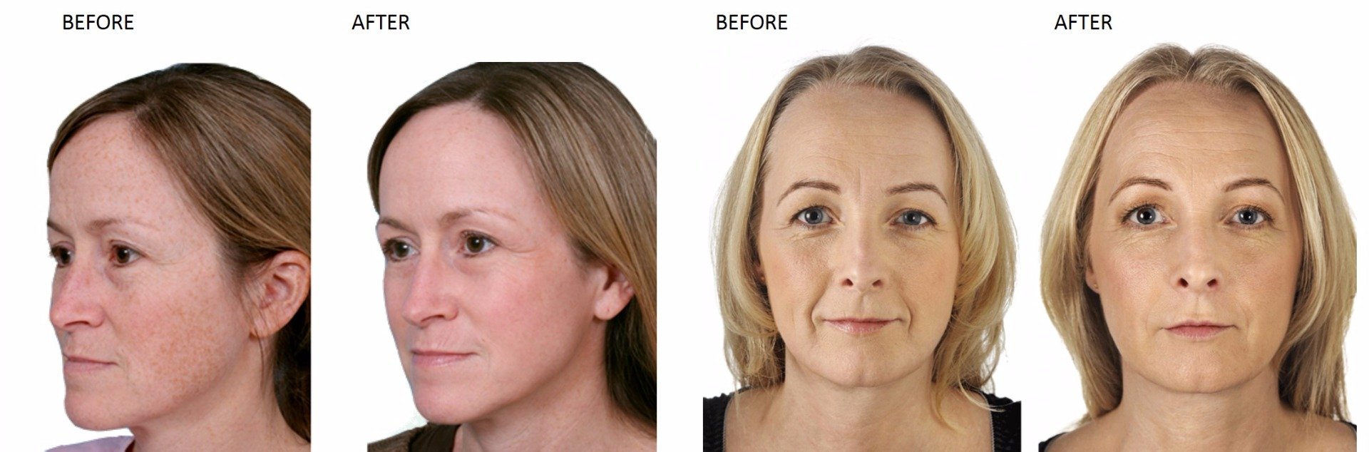 Laser Skin Rejuvenation at Total Body Care