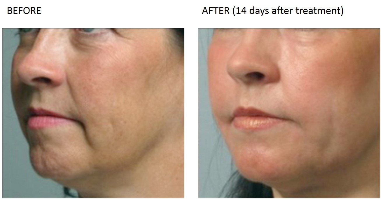Laser Skin Rejuvenation at Total Body Care