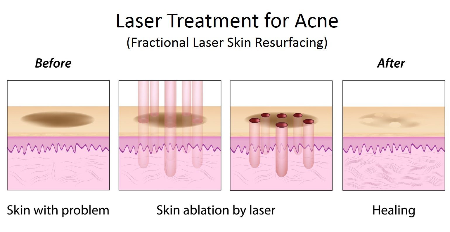 Acne treatment with Laser at Total Body Care