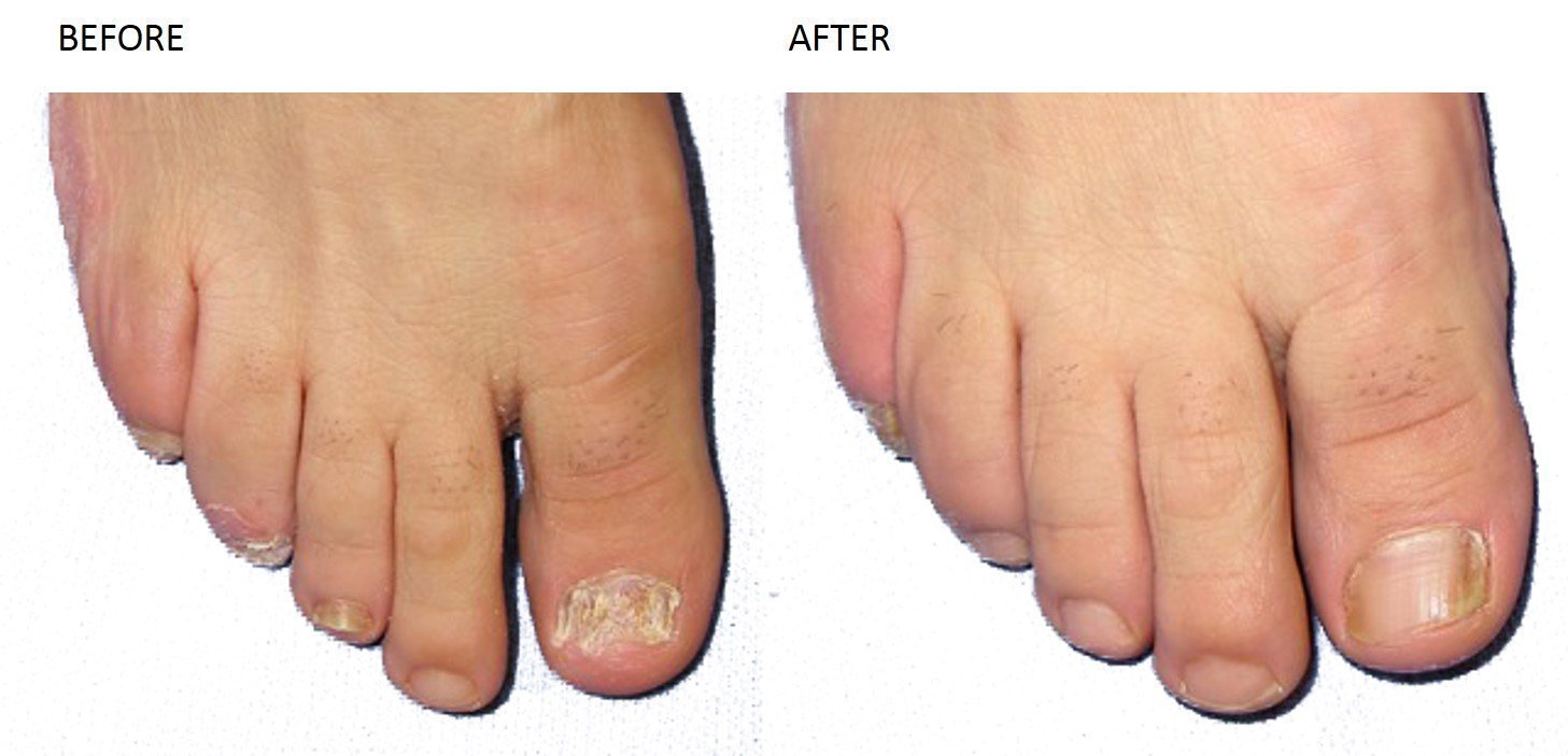 Nail Fungus Treatment – With Laser