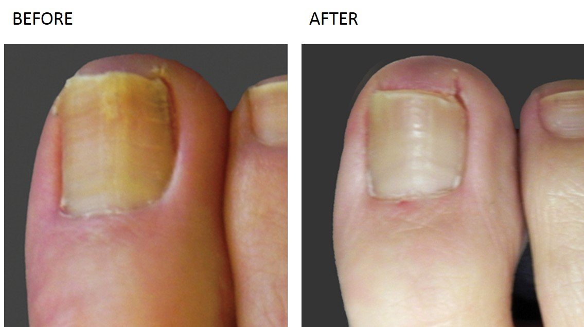 Nail Fungus Treatment at Total Body Care