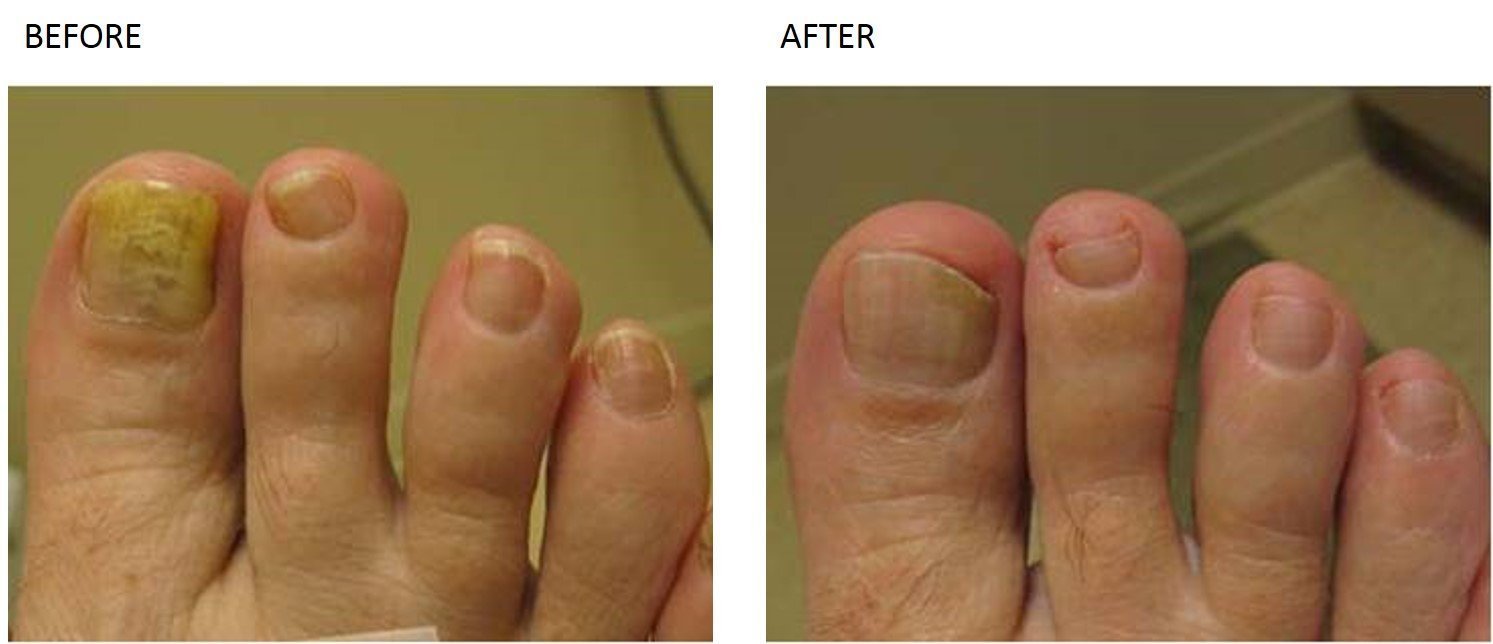 Nail Fungus Treatment at Total Body Care