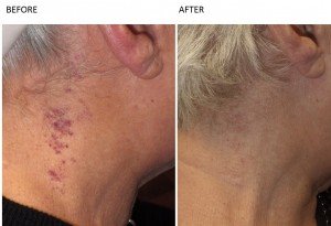 Pigmentation Treatment Vascular Lesions at Total Body Care