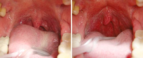 Snoring Treatment with Laser at Total Body Care