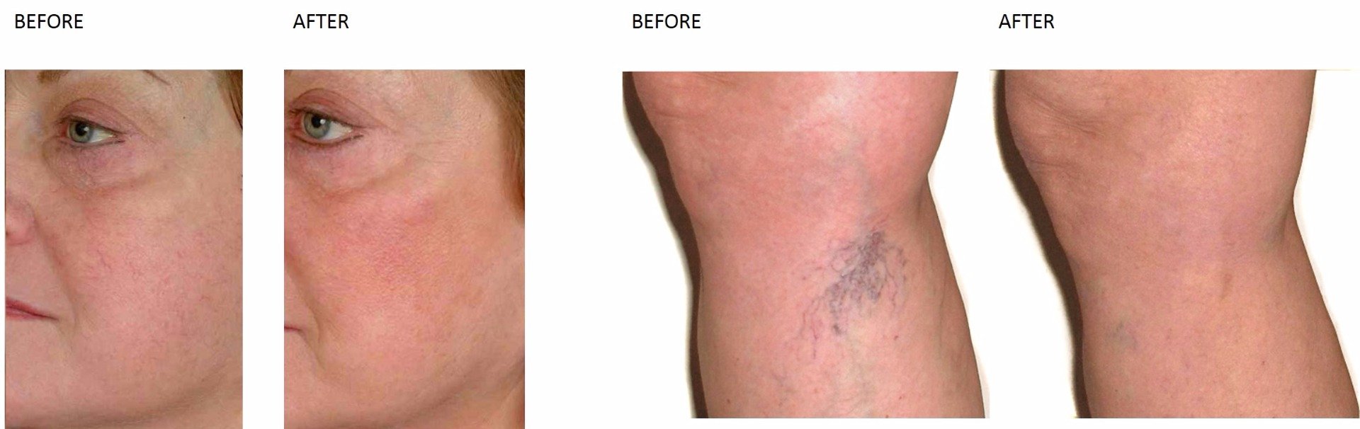 Thread Vein Treatment at Total Body Care