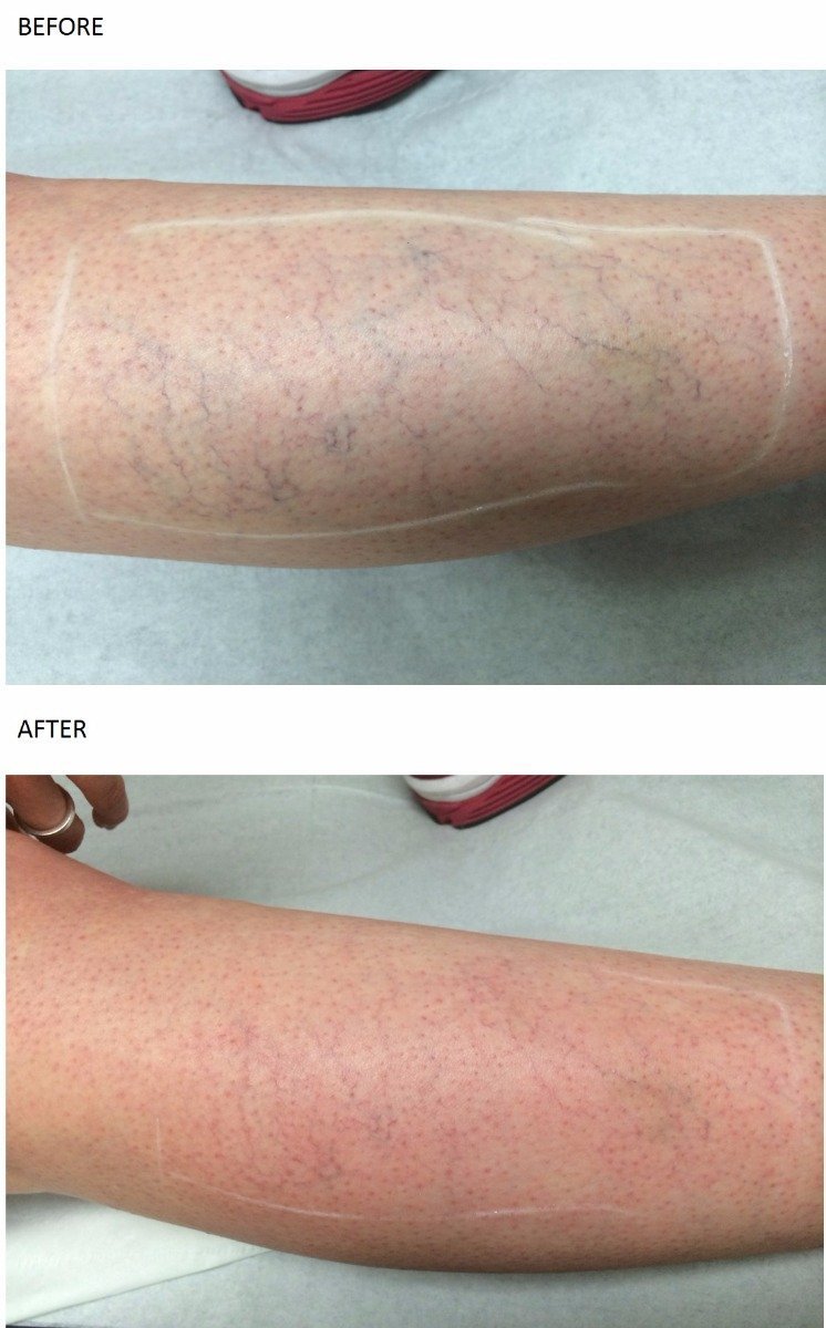 Thread Vein Treatment at Total Body Care