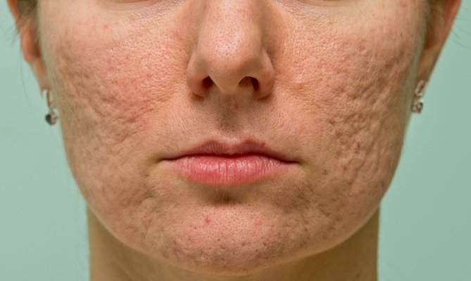 Acne and Acne Scar Treatment at Total Body Care