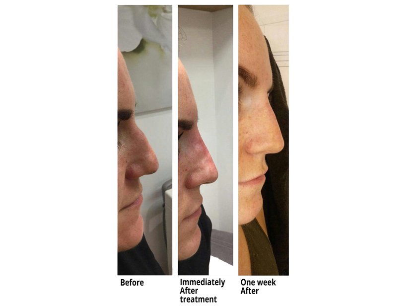 Non Surgical Rhinoplasty Nose Job at Total Body Care